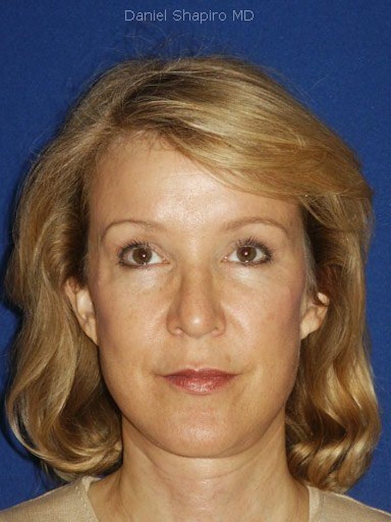 Facelift Before & After Gallery - Patient 17337638 - Image 2