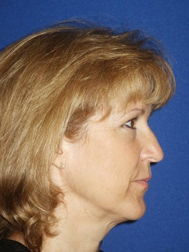 Facelift Before & After Gallery - Patient 17337638 - Image 3
