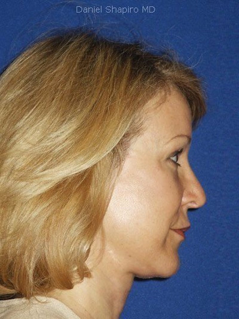 Facelift Before & After Gallery - Patient 17337638 - Image 4