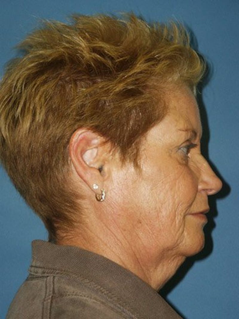 Facelift Before & After Gallery - Patient 17337642 - Image 3