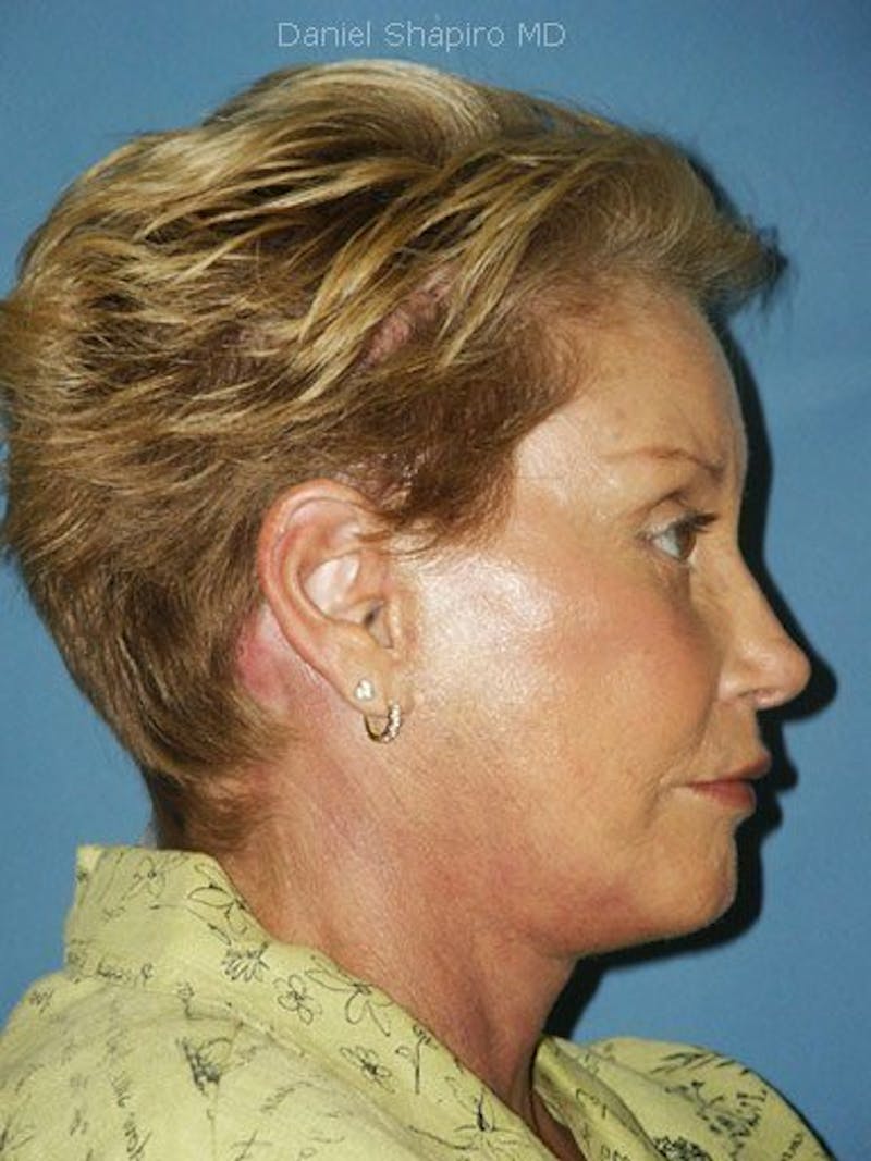 Facelift Before & After Gallery - Patient 17337642 - Image 4