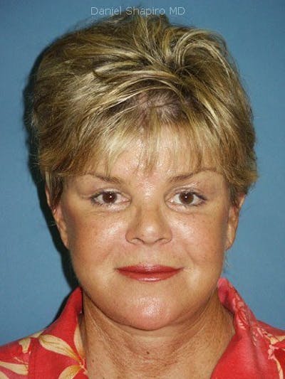 Facelift Before & After Gallery - Patient 17337643 - Image 2