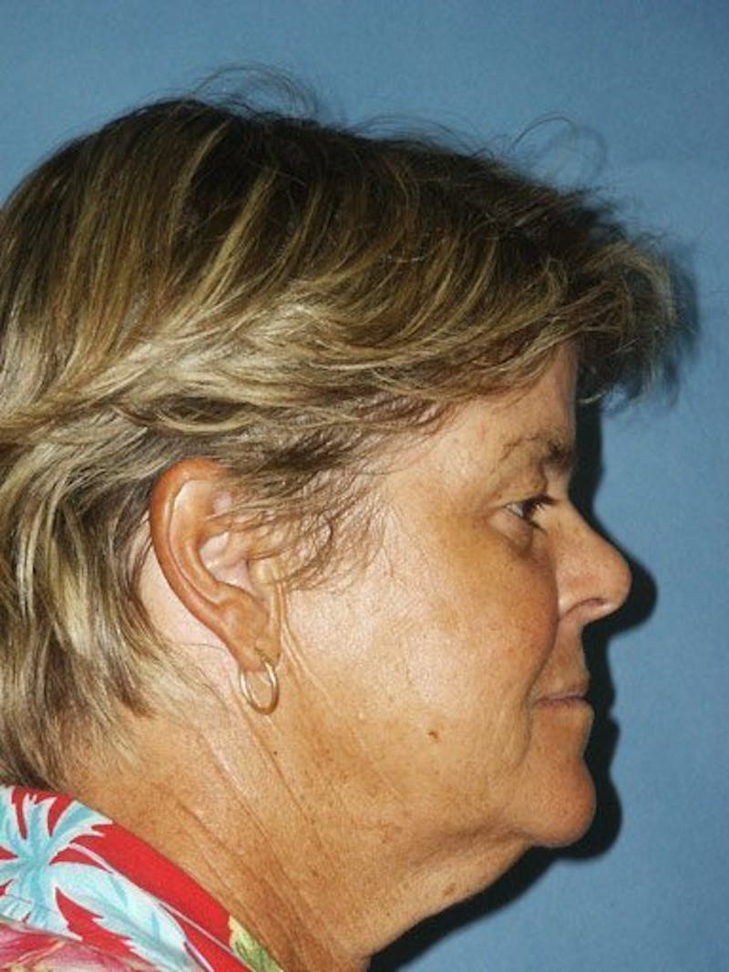 Facelift Before & After Gallery - Patient 17337643 - Image 3