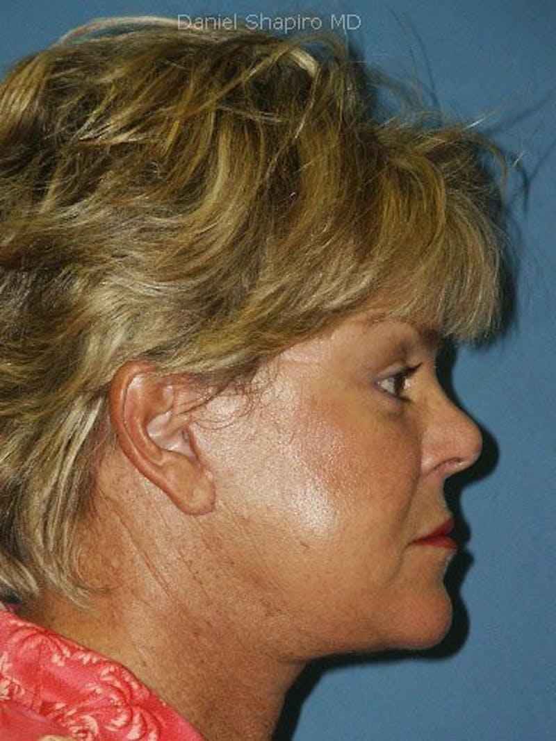 Facelift Before & After Gallery - Patient 17337643 - Image 4