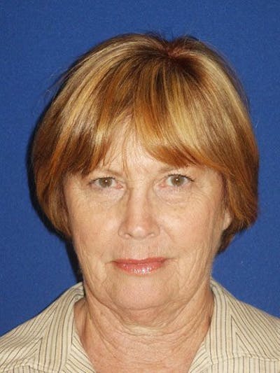 Facelift Before & After Gallery - Patient 17337644 - Image 1