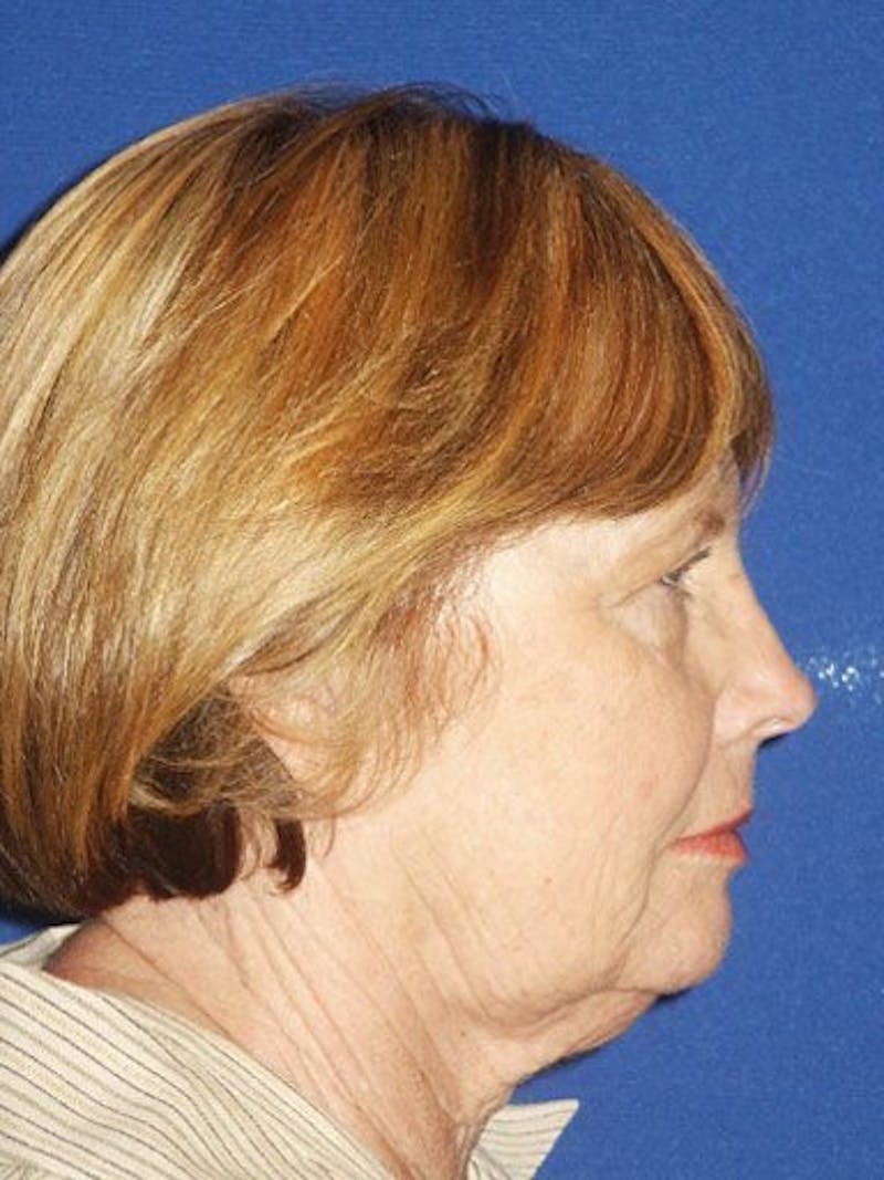 Facelift Before & After Gallery - Patient 17337644 - Image 3