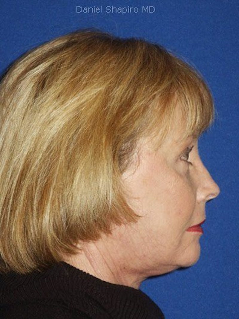 Facelift Before & After Gallery - Patient 17337644 - Image 4
