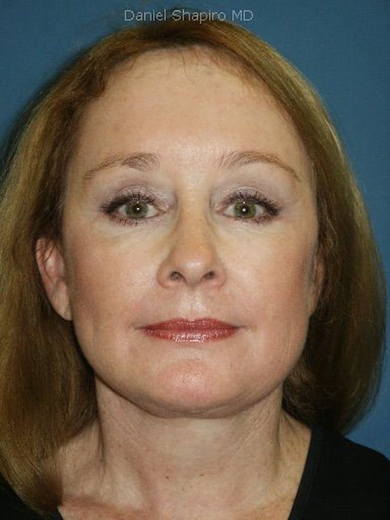 Facelift Before & After Gallery - Patient 17339204 - Image 2