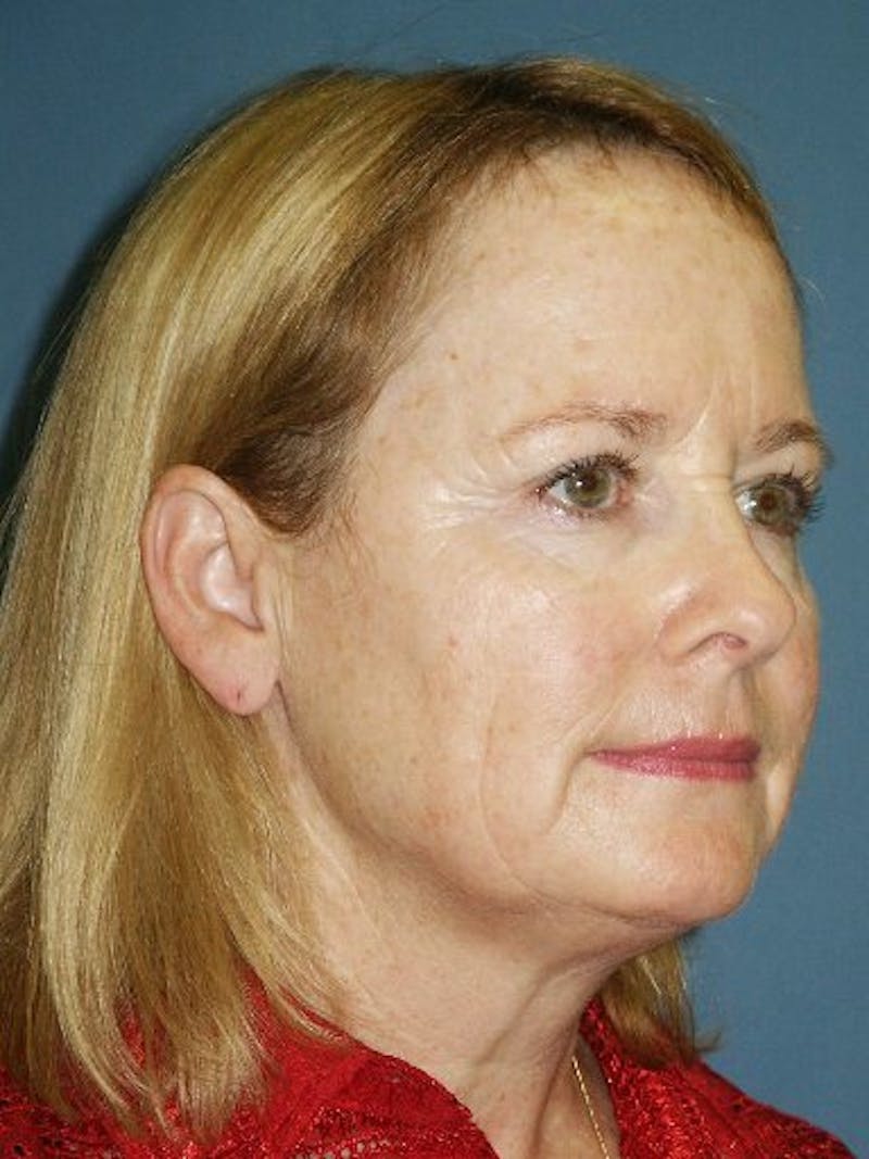 Facelift Before & After Gallery - Patient 17339204 - Image 3