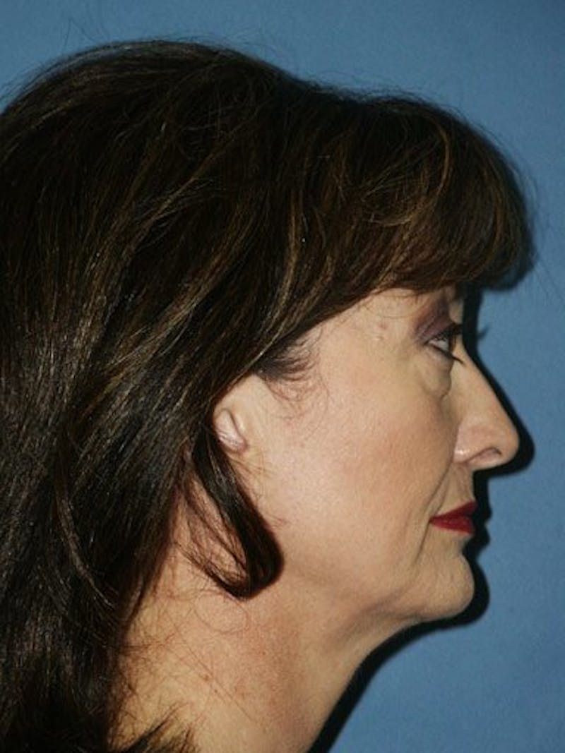 Facelift Before & After Gallery - Patient 17339231 - Image 3