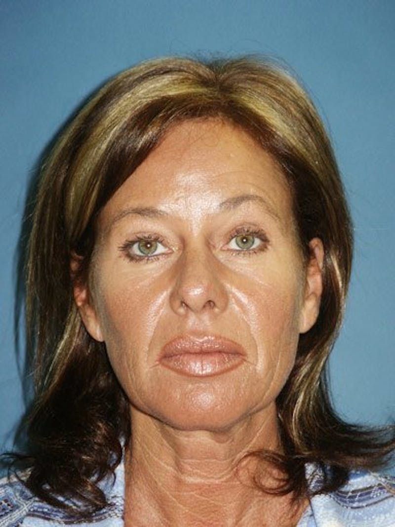 Facelift Before & After Gallery - Patient 17339233 - Image 1