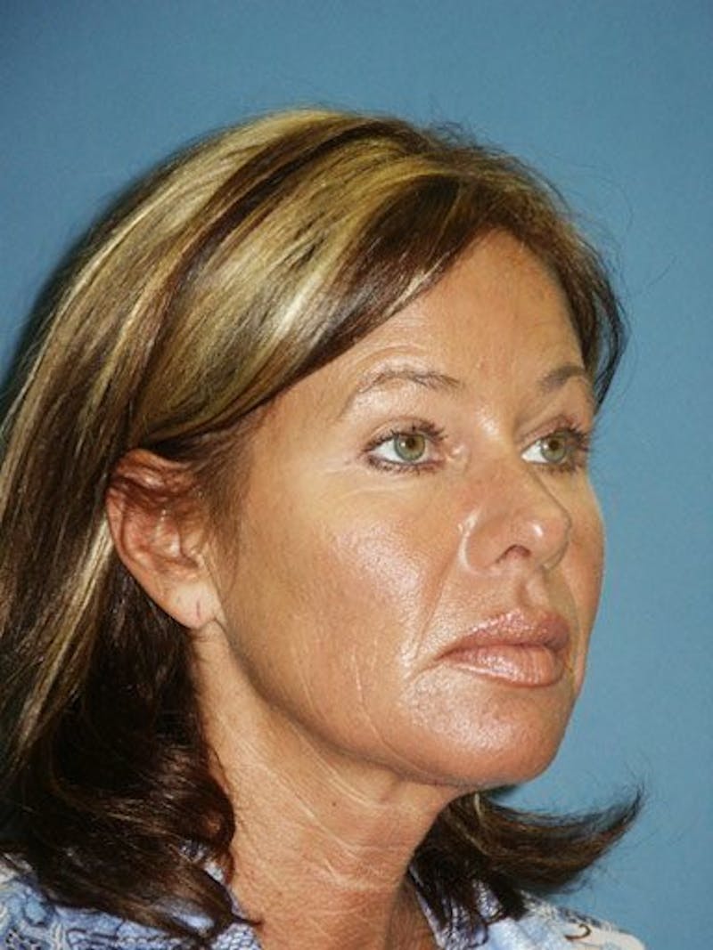 Facelift Before & After Gallery - Patient 17339233 - Image 3