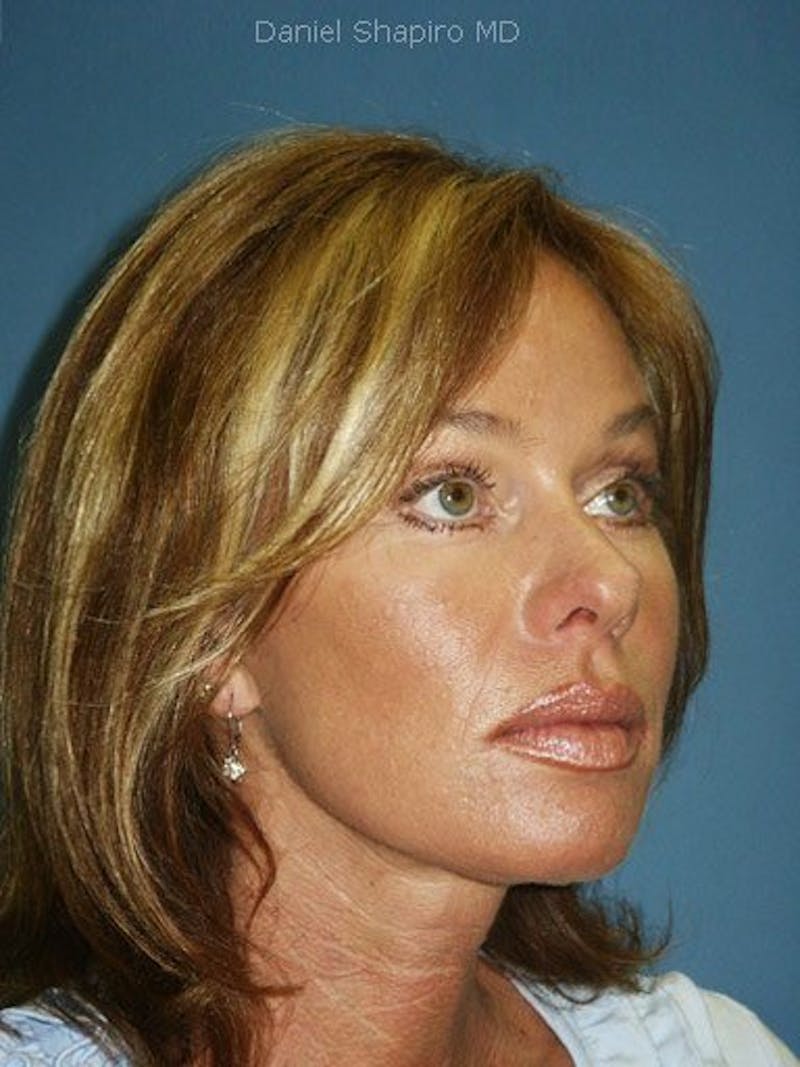 Facelift Before & After Gallery - Patient 17339233 - Image 4