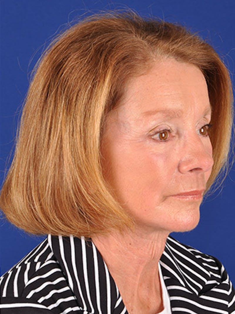 Facelift Before & After Gallery - Patient 17339236 - Image 4