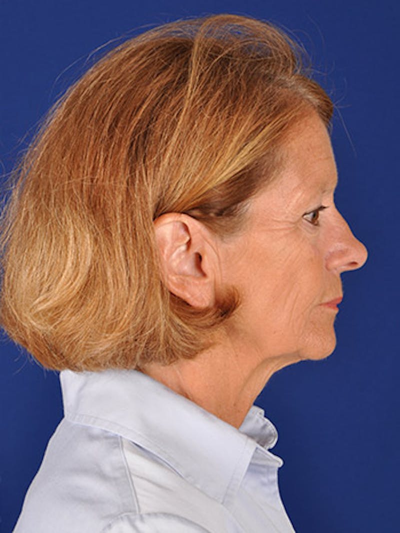 Facelift Before & After Gallery - Patient 17339236 - Image 5