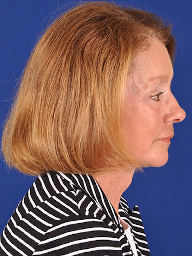 Facelift Before & After Gallery - Patient 17339236 - Image 6