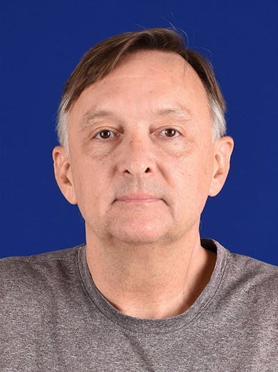 Facial Rejuvenation Before & After Gallery - Patient 18264904 - Image 1