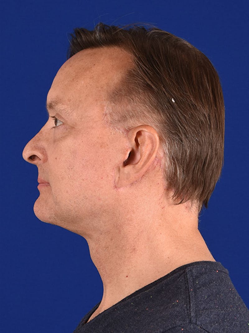 Male Facial Rejuvenation Before & After Gallery - Patient 17339259 - Image 6