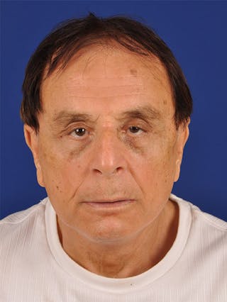Facial Rejuvenation Before & After Gallery - Patient 18264905 - Image 2