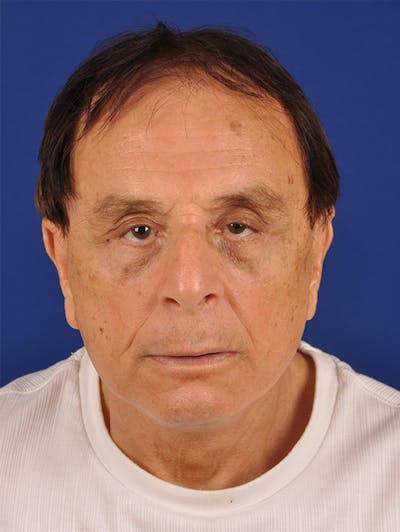 Facial Rejuvenation Before & After Gallery - Patient 18264905 - Image 2