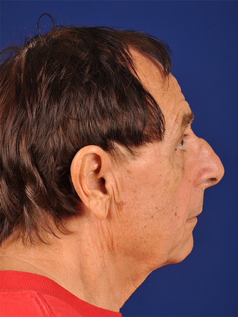 Male Facial Rejuvenation Before & After Gallery - Patient 17339261 - Image 5
