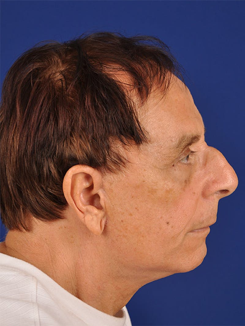 Male Facial Rejuvenation Before & After Gallery - Patient 17339261 - Image 6