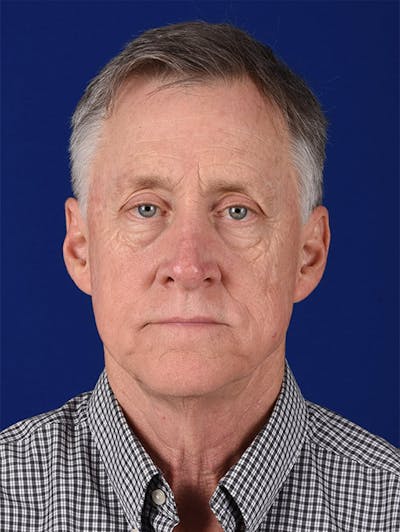 Facial Rejuvenation Before & After Gallery - Patient 18264906 - Image 1