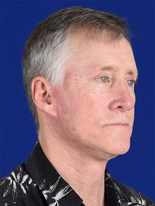 Facial Rejuvenation Before & After Gallery - Patient 18264906 - Image 4