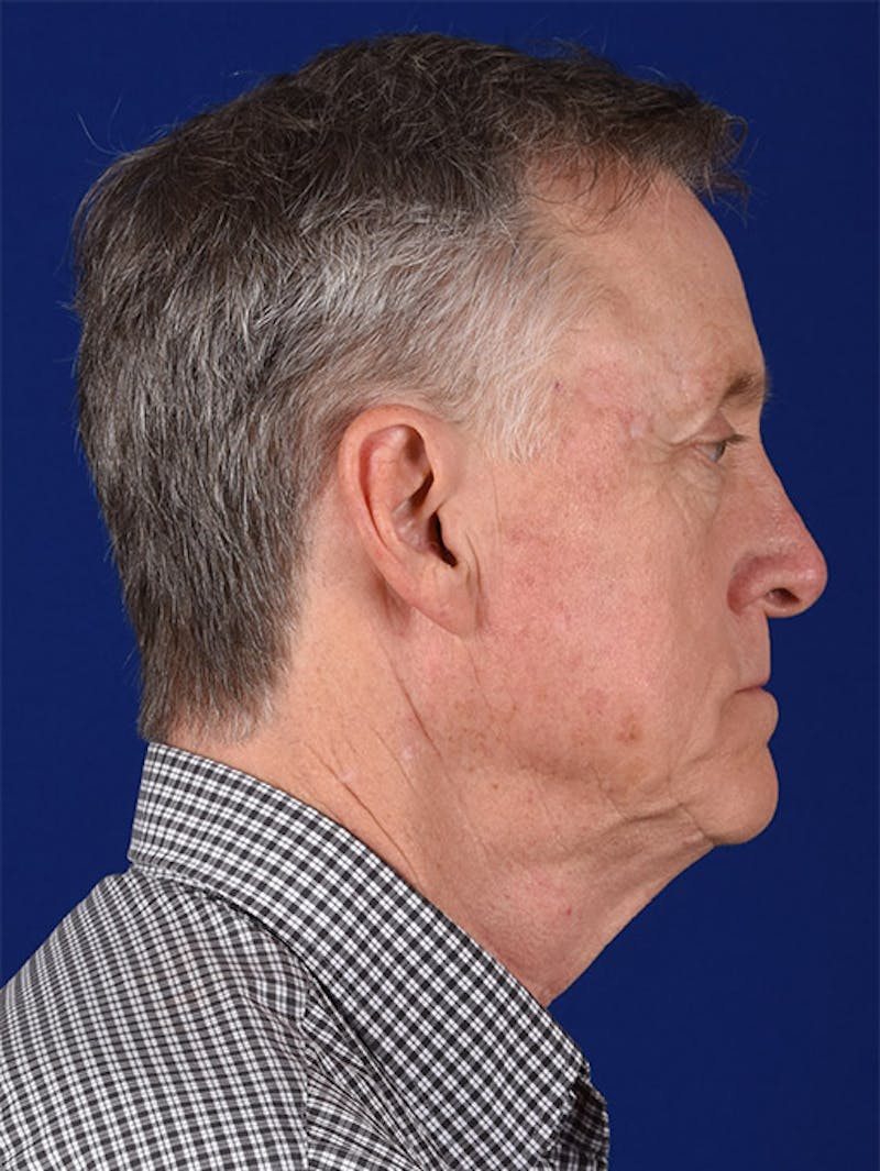 Male Facial Rejuvenation Before & After Gallery - Patient 17339262 - Image 5