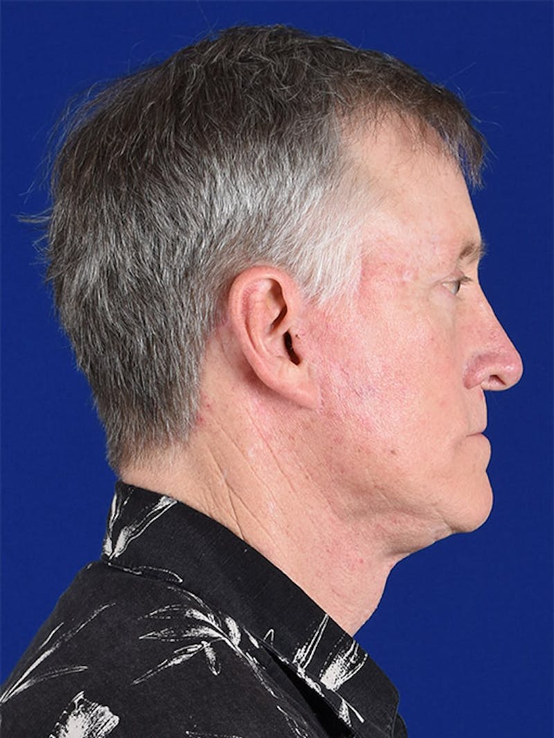 Facial Rejuvenation Before & After Gallery - Patient 18264906 - Image 6