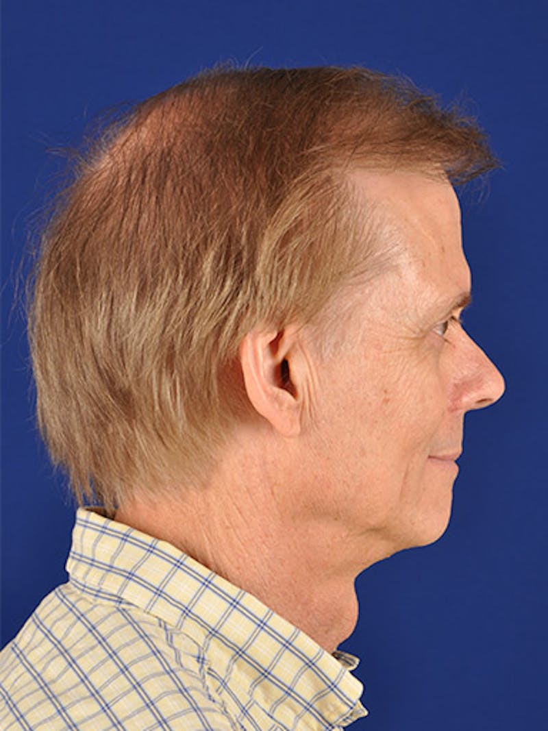 Facial Rejuvenation Before & After Gallery - Patient 18264907 - Image 5