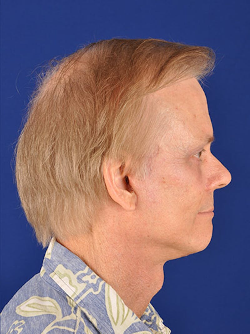 Male Facial Rejuvenation Before & After Gallery - Patient 17339264 - Image 6