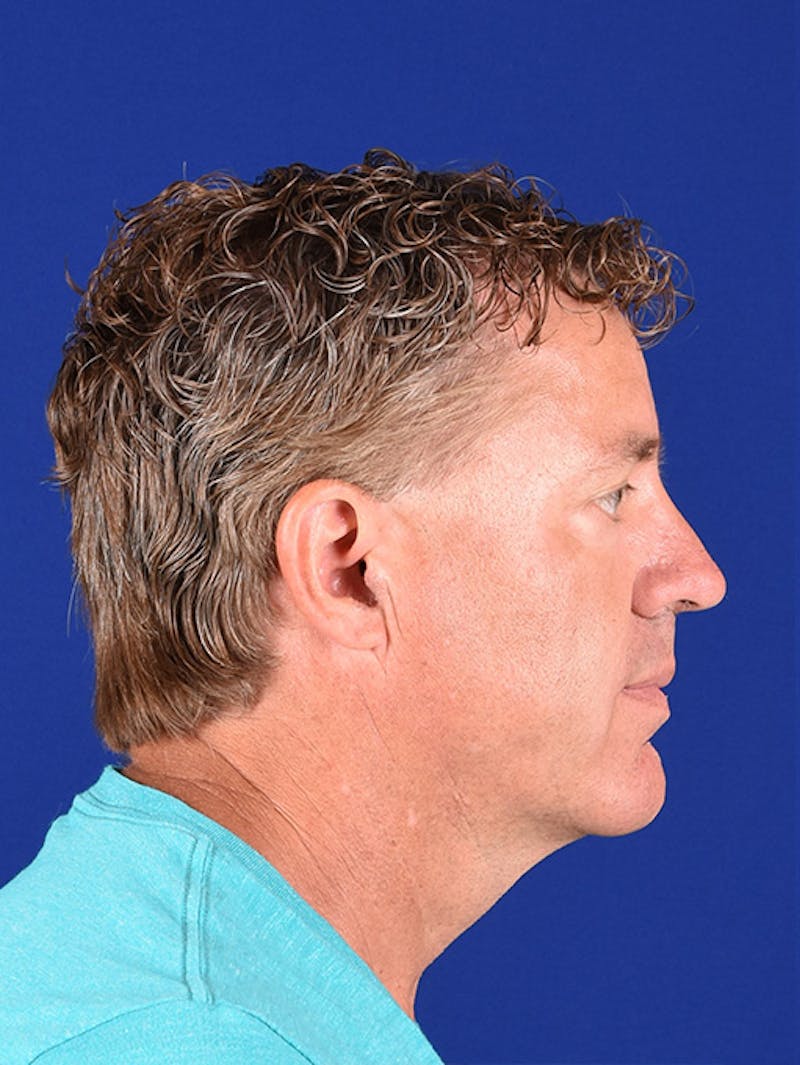 Male Facial Rejuvenation Before & After Gallery - Patient 17339268 - Image 6