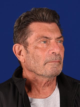 Facial Rejuvenation Before & After Gallery - Patient 18264910 - Image 4