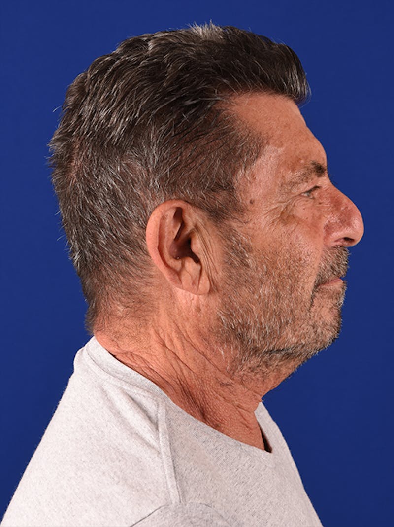 Male Facial Rejuvenation Before & After Gallery - Patient 17340829 - Image 5