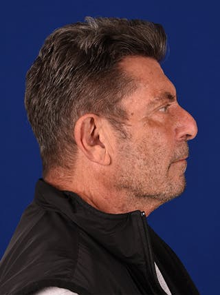 Facial Rejuvenation Before & After Gallery - Patient 18264910 - Image 6