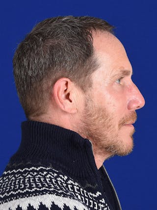 Facial Rejuvenation Before & After Gallery - Patient 18264911 - Image 6