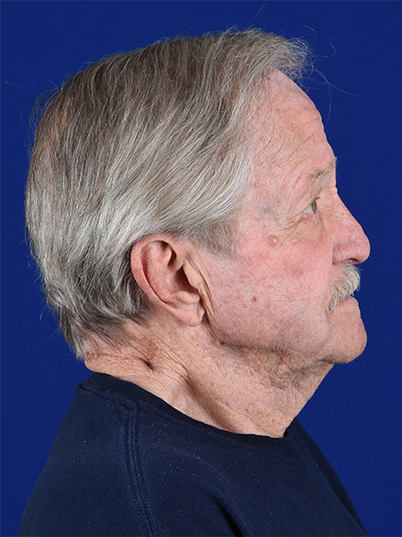 Male Facial Rejuvenation Before & After Gallery - Patient 17342416 - Image 5