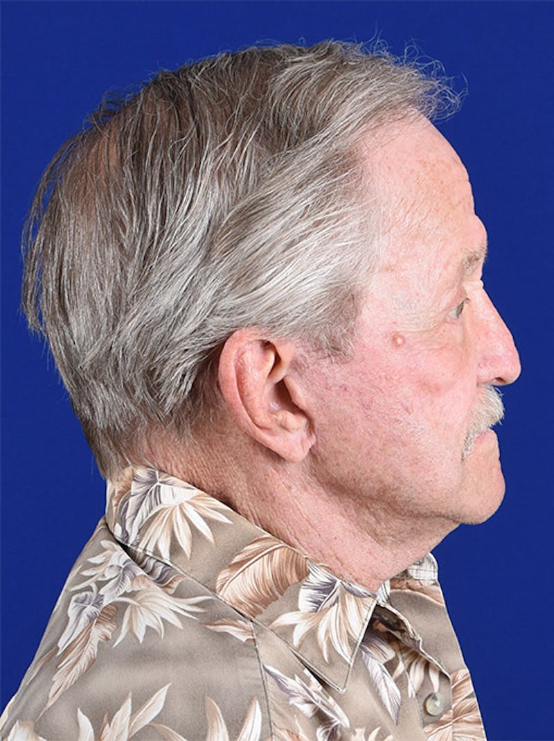 Facial Rejuvenation Before & After Gallery - Patient 18264912 - Image 6