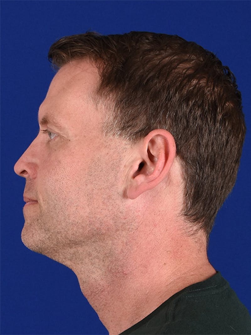 Facial Rejuvenation Before & After Gallery - Patient 18264913 - Image 6