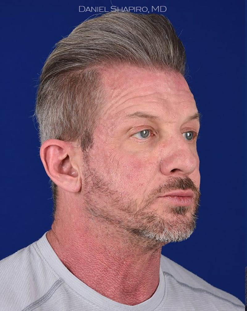 Male Facial Rejuvenation Before & After Gallery - Patient 17342421 - Image 3