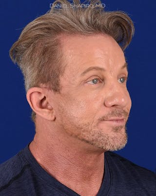 Facial Rejuvenation Before & After Gallery - Patient 18264914 - Image 4