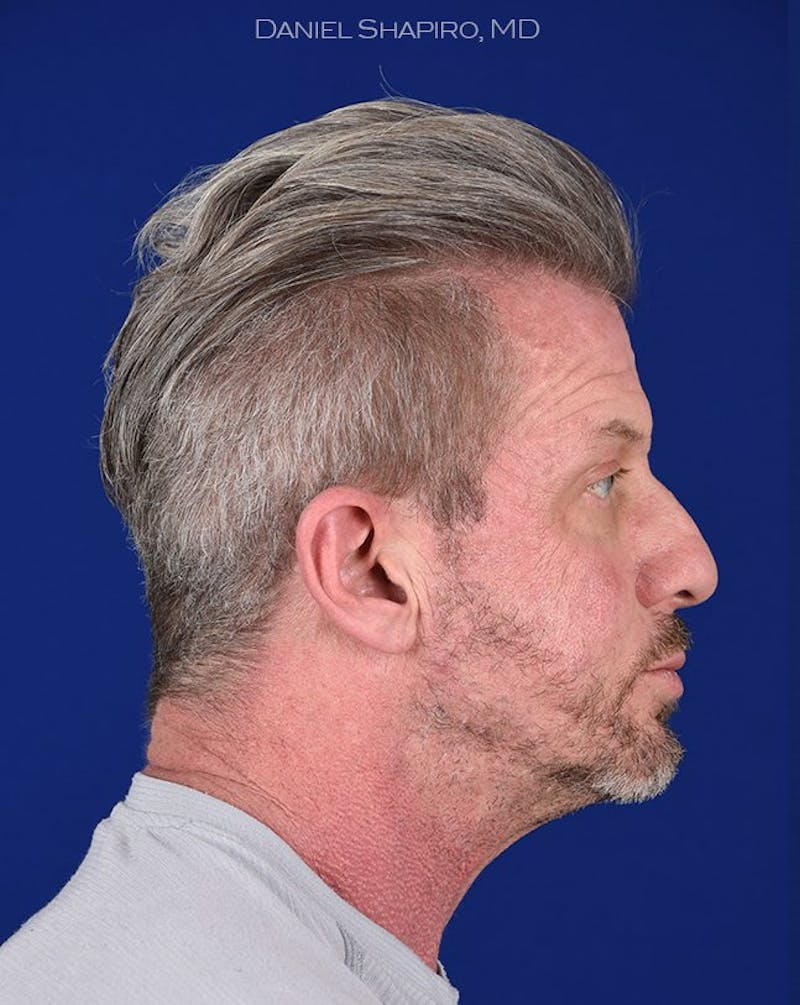 Male Facial Rejuvenation Before & After Gallery - Patient 17342421 - Image 5