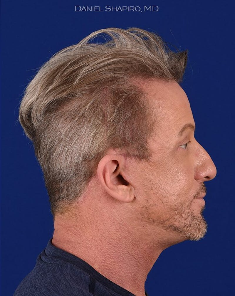 Male Facial Rejuvenation Before & After Gallery - Patient 17342421 - Image 6