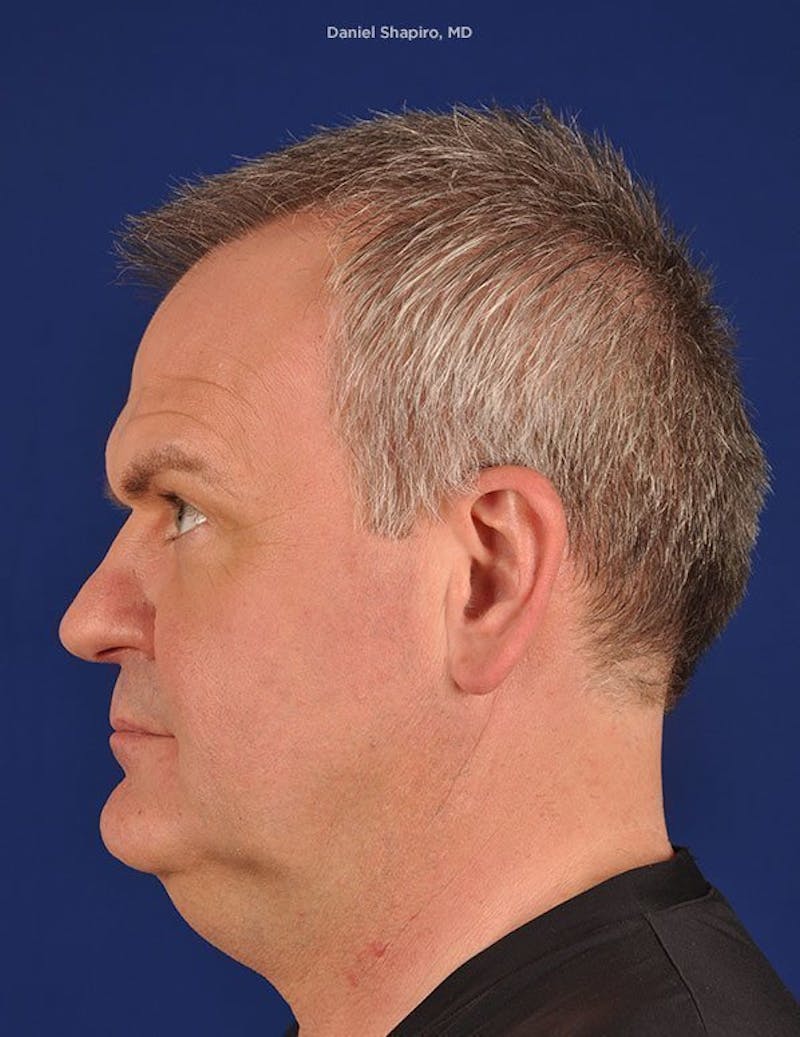 Male Facial Rejuvenation Before & After Gallery - Patient 17342425 - Image 5