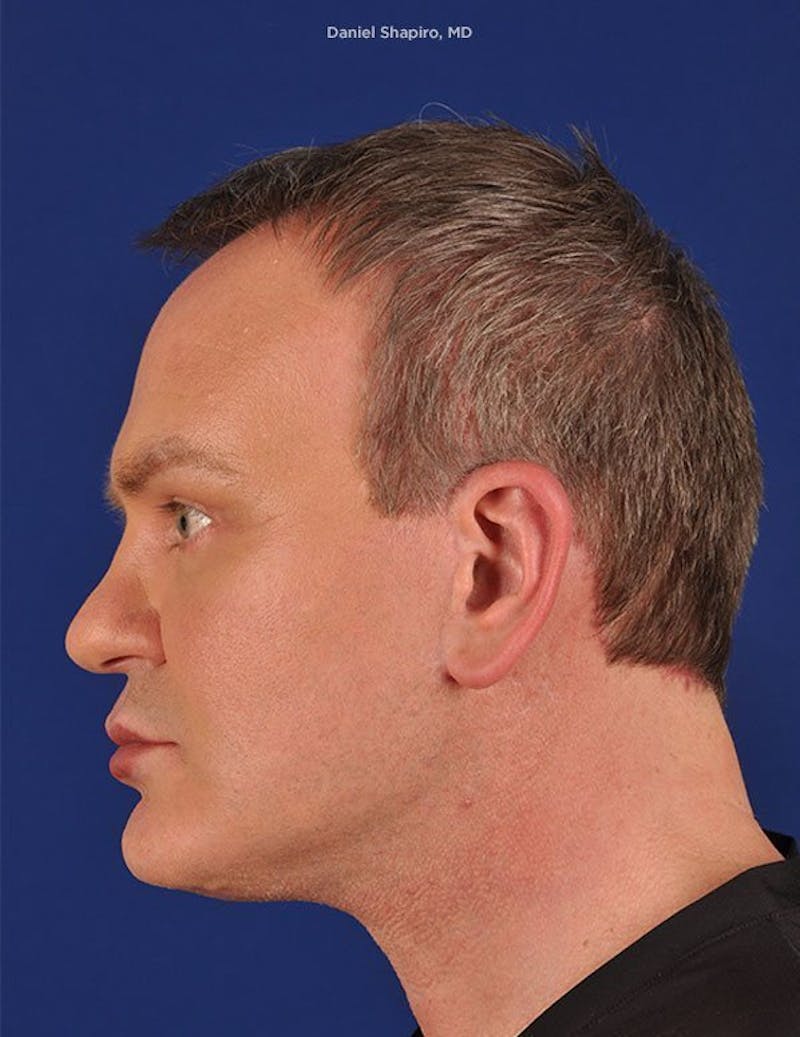 Male Facial Rejuvenation Before & After Gallery - Patient 17342425 - Image 6