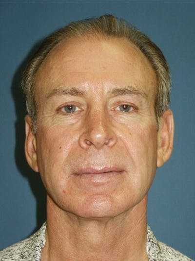 Facial Rejuvenation Before & After Gallery - Patient 18264918 - Image 1