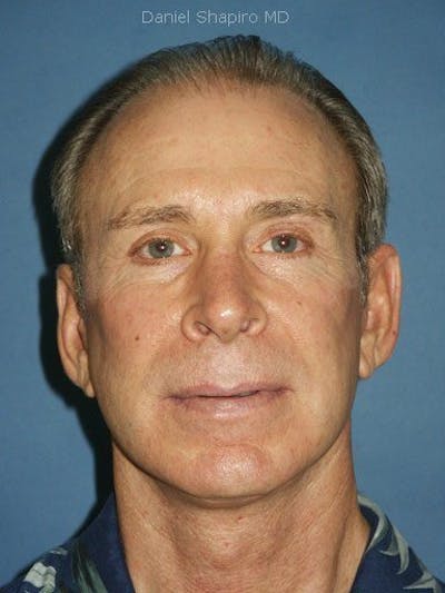 Facial Rejuvenation Before & After Gallery - Patient 18264918 - Image 2