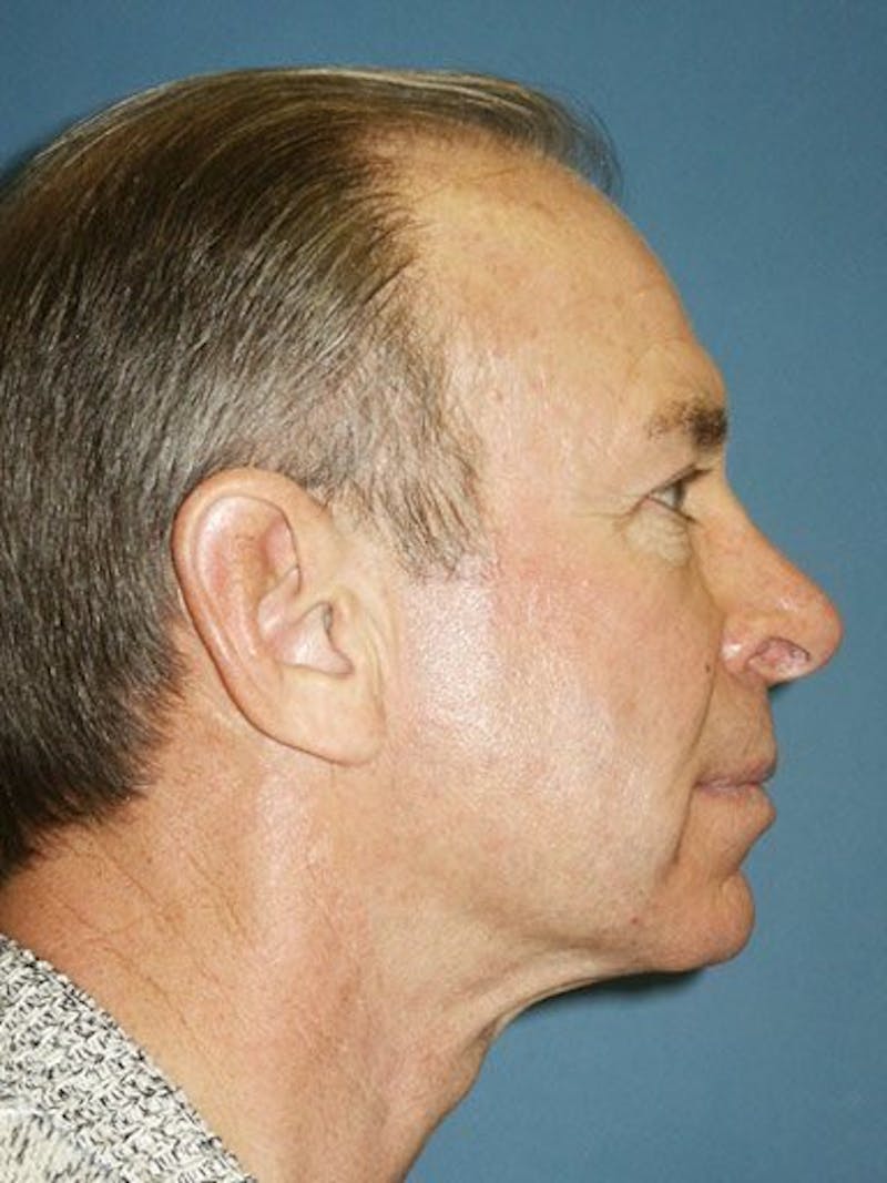 Facial Rejuvenation Before & After Gallery - Patient 18264918 - Image 3