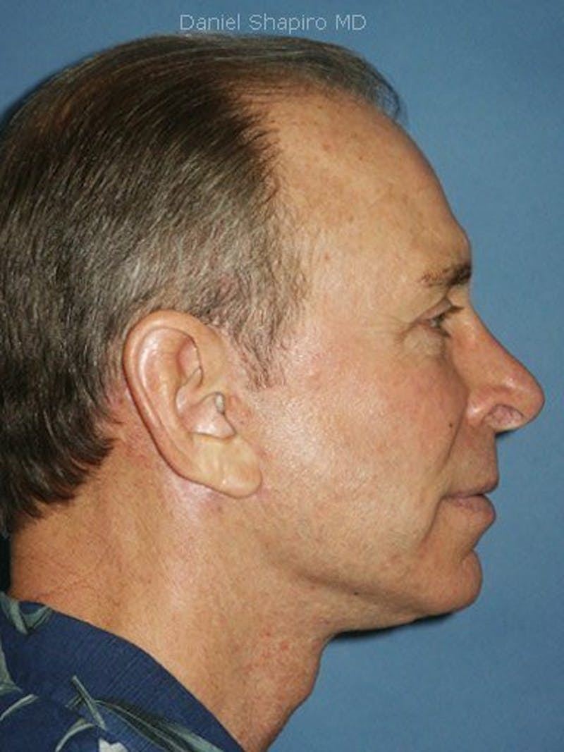 Male Facial Rejuvenation Before & After Gallery - Patient 17344027 - Image 4